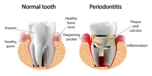 Periodontitis disease